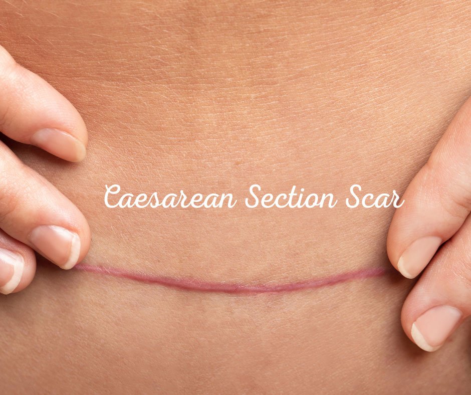 c section scar Check post natal recovery